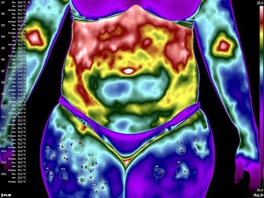 Lipodistrofia ginoide e termografia