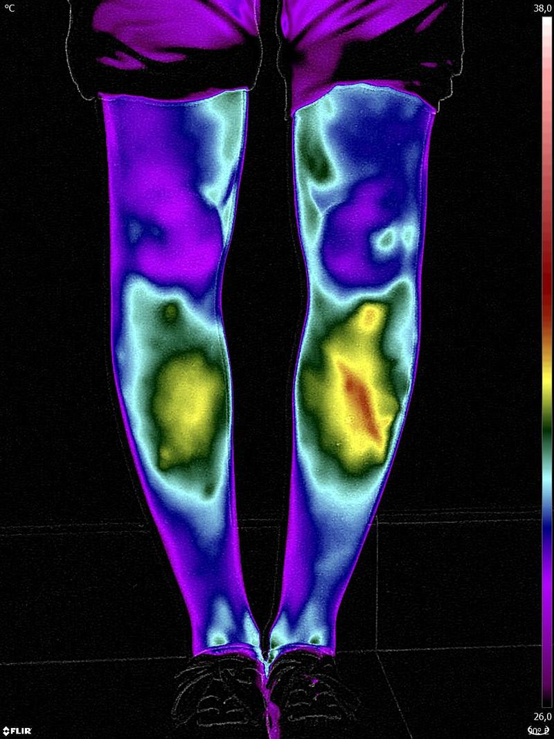 Termografia na fisioterapia e educação física